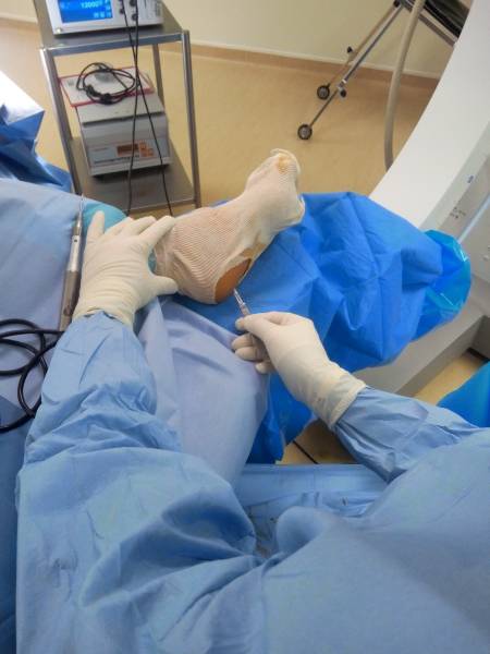 Epine calcanéenne et aponévrosite plantaire