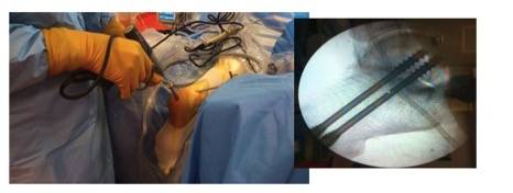 Arthrodèse sous talienne