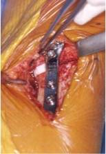 photo per opératoire ostéotomie du tibia : coin osseux, plaque et substitut osseux.