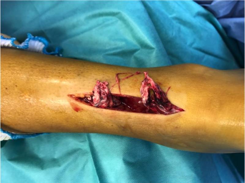 aspect du tendon qui est effiloché 